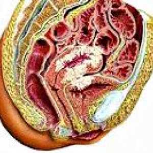 Tumorile maligne ale uterului